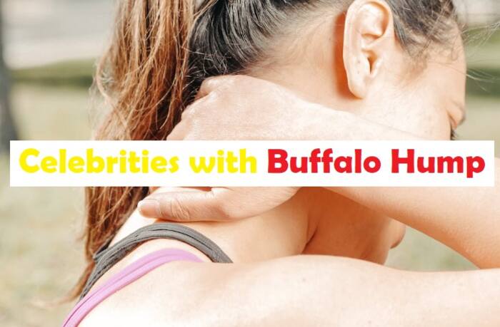 Celebrities with Buffalo Hump